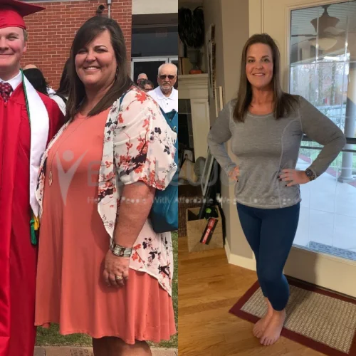 After Gastric Sleeve Surgery